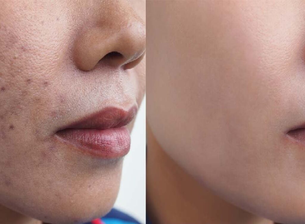 ACNE