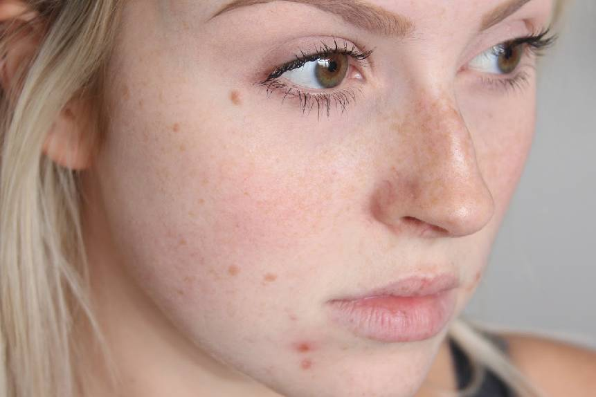Acne