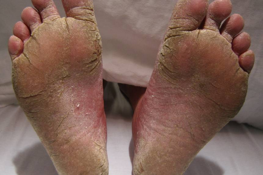 Fungal Infection