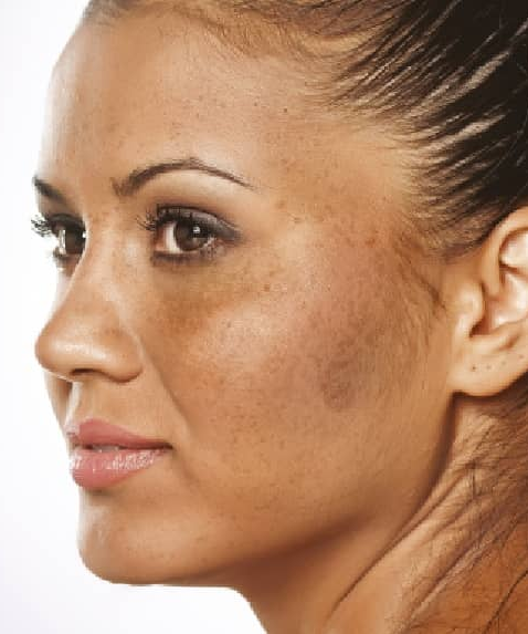 Melasma