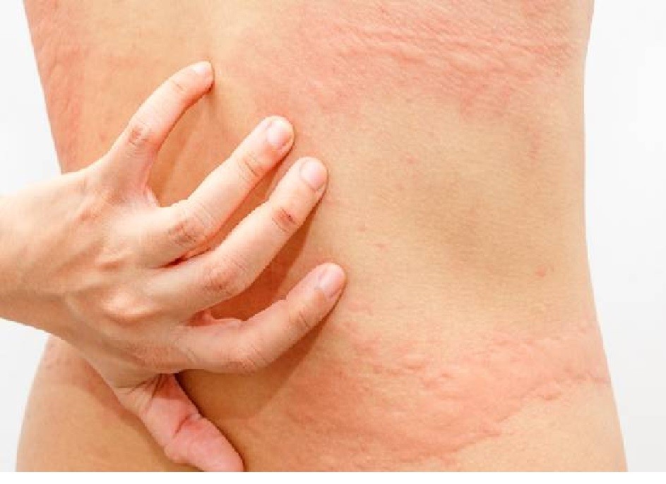 Urticaria