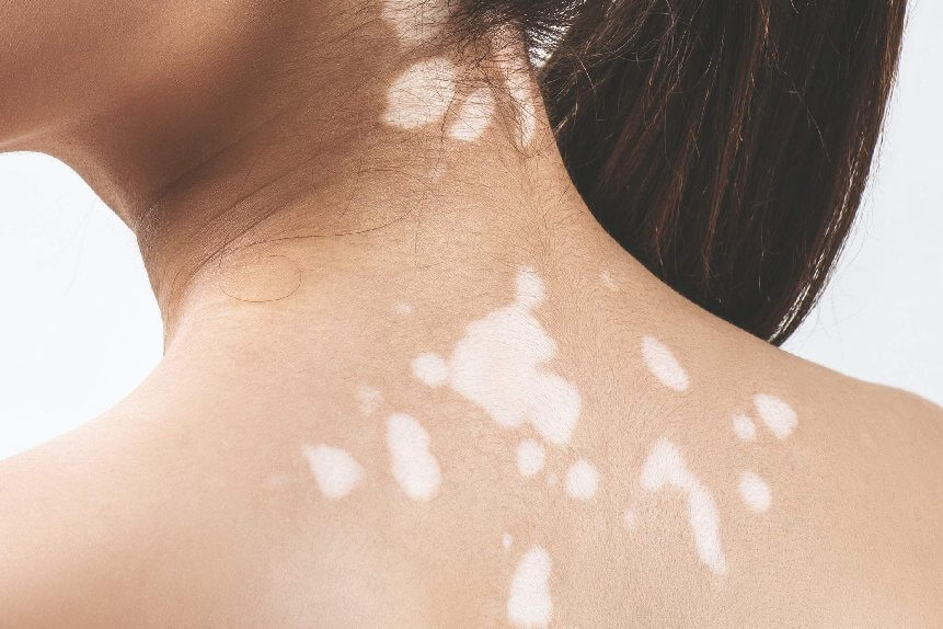 Vitiligo